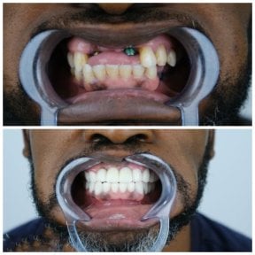 before-after photo dental-implant