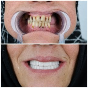 before-after photo dental-implant