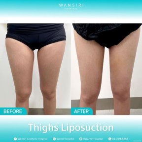 before-after photo liposakciya