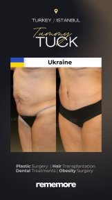 before-after photo 360-liposuction