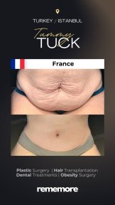 before-after photo 360-liposuction