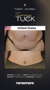 before-after photo 360-liposuction