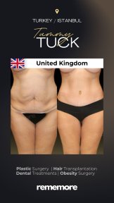 before-after photo 360-liposuction