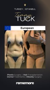 before-after photo 360-liposuction