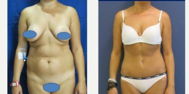 before-after photo liposuction