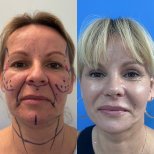 Facelift before and after results – facial rejuvenation and smoother skin appearance