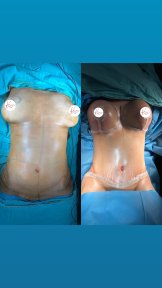 Before and after breast augmentation results – enhanced breast size and contour improvement