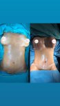Before and after breast augmentation results – enhanced breast size and contour improvement