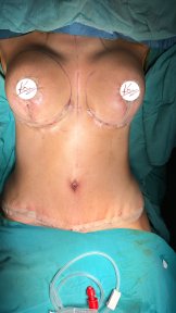 Mommy makeover result with breast lift and tummy tuck, visible contour improvement post-surgery