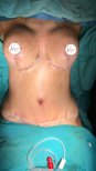 Mommy makeover result with breast lift and tummy tuck, visible contour improvement post-surgery
