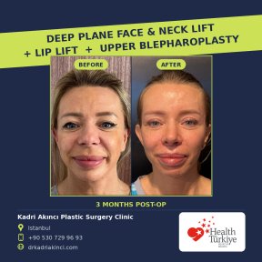 Before and after deep plane facelift, neck lift, lip lift, blepharoplasty at Kadri Akinci Clinic