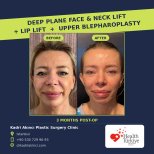 Before and after deep plane facelift, neck lift, lip lift, blepharoplasty at Kadri Akinci Clinic