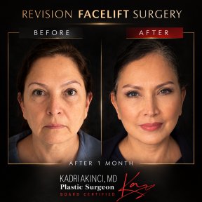 Before and after revision facelift results at Kadri Akinci clinic, visible facial rejuvenation