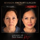 Before and after revision facelift results at Kadri Akinci clinic, visible facial rejuvenation