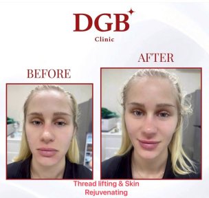 before-after photo botox-injections