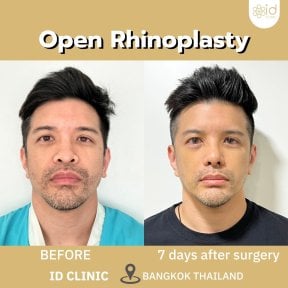 before-after photo rhinoplasty-nose-job