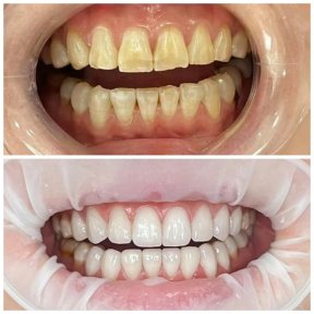 before-after photo installation-of-a-veneer