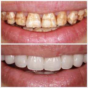 before-after photo installation-of-a-veneer