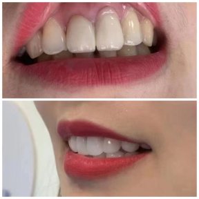 before-after photo installation-of-a-veneer