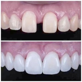 before-after photo installation-of-a-veneer