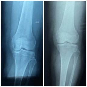 before-after photo osteoarthritis-stem-cell-treatment