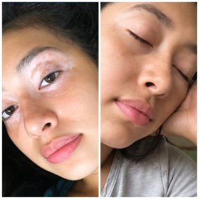 before-after photo course-of-treatment-with-donor-stem-cells