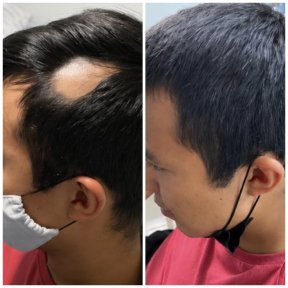 before-after photo course-of-treatment-with-donor-stem-cells
