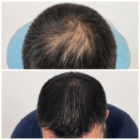 before-after photo course-of-treatment-with-donor-stem-cells