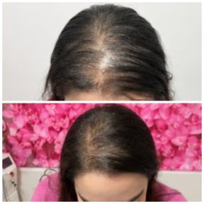 before-after photo course-of-treatment-with-donor-stem-cells