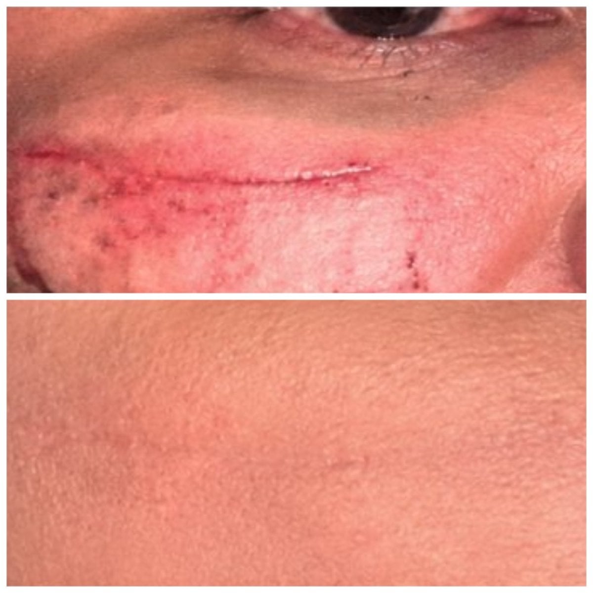 نتائج تقليل الندبات بعد علاج الإكسوسومات في مركز CellsClinic للطب التجديدي