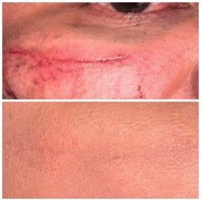 before-after photo exosome