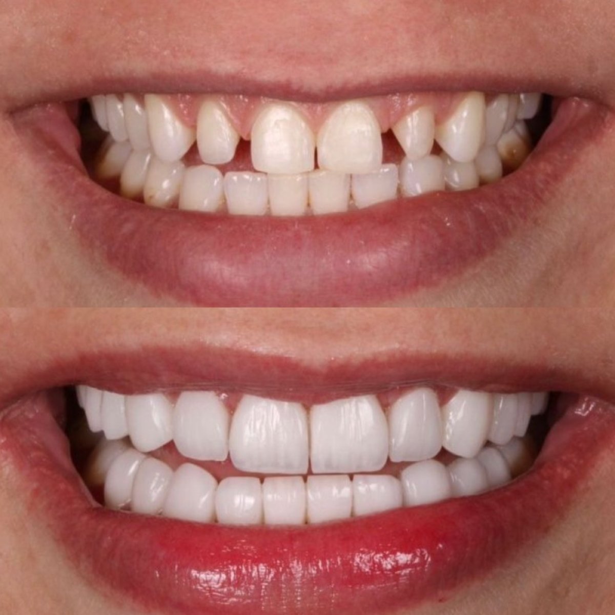 Resultado antes y después de carillas en Clínica Zago Dental Clinic – transformación de sonrisa
