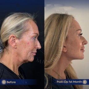 before-after photo deep-plane-facelift