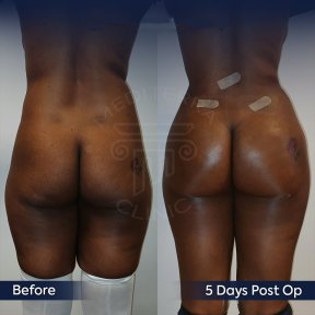 before-after photo mommy-makeover