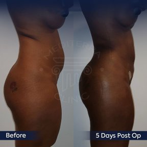before-after photo mommy-makeover