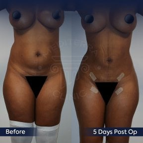 before-after photo mommy-makeover