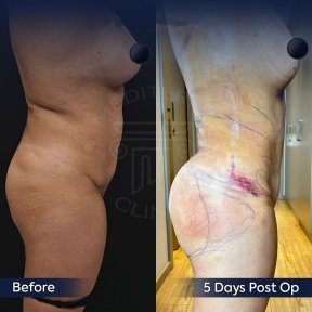 before-after photo mommy-makeover
