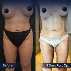 before-after photo mommy-makeover