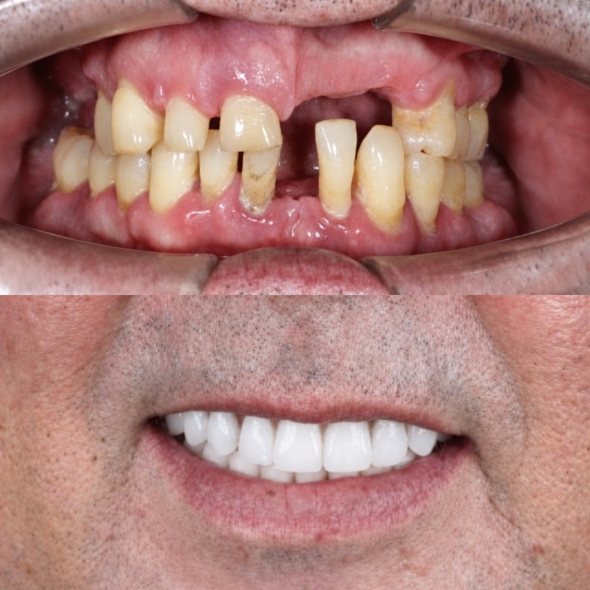 Resultados antes y después de implantes All-on-6 en SmileBox Dental Clinic - Thonglor, Sukhumvit