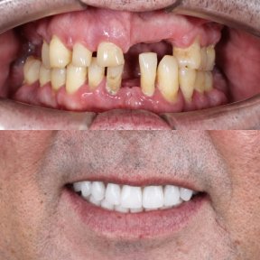 before-after photo all-on-6-dental-implants