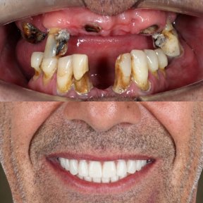 before-after photo all-on-6-dental-implants