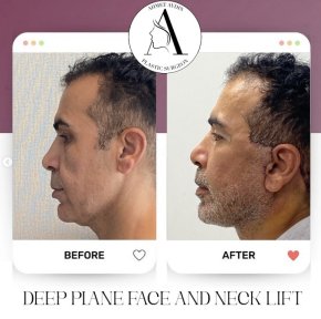 before-after photo deep-plane-facelift