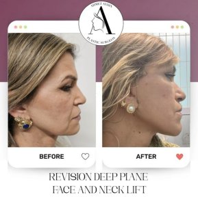 before-after photo deep-plane-facelift