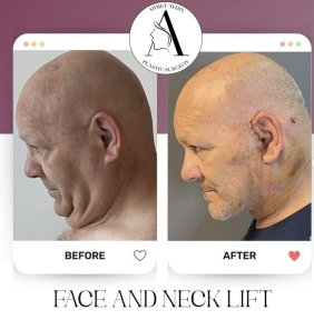 before-after photo deep-plane-facelift