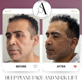 before-after photo deep-plane-facelift