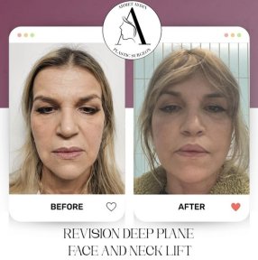 before-after photo deep-plane-facelift