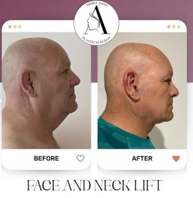 before-after photo deep-plane-facelift