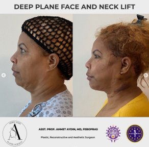 before-after photo deep-plane-facelift