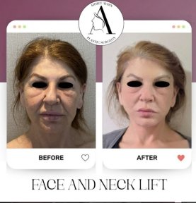 before-after photo deep-plane-facelift