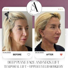 before-after photo deep-plane-facelift